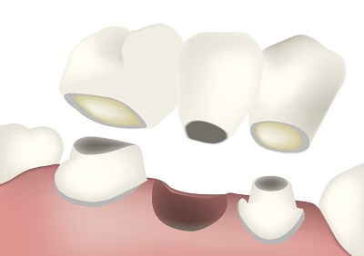 Choosing Between a Dental Crown or a Dental Bridge