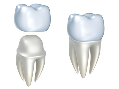 How Do You Tell You Are Allergic To Your Dental Crowns