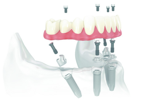 Benefits of Implant-Retained Denture