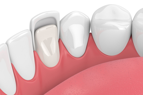 3D rendering of teeth with a ceramic veneer.