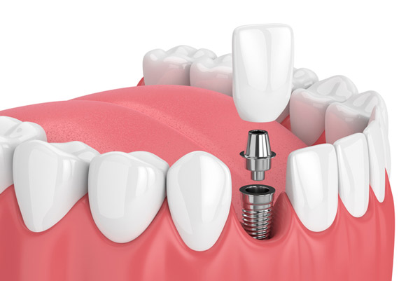 Photo St. Louis Prosthodontics in St. Louis, MO