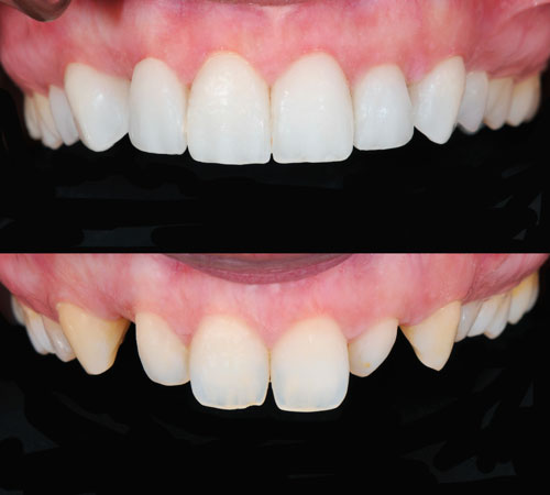 Photo of peg teeth fromSt. Louis Prosthodontics in St. Louis, MO