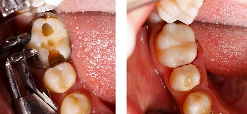 Photo of dental filling at St. Louis Prosthodontics in St. Louis, MO